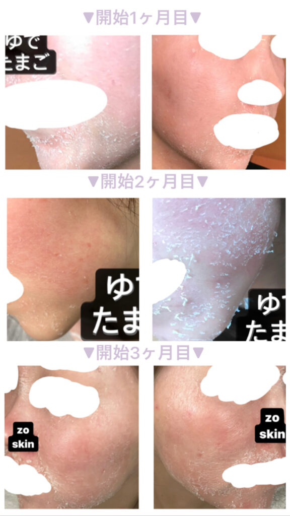 ゼオスキンセラピューティック　1ヶ月目〜3ヶ月目の皮剥けの様子の写真